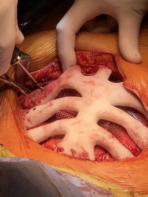 StarPore ribcage being fixed into position with screws.