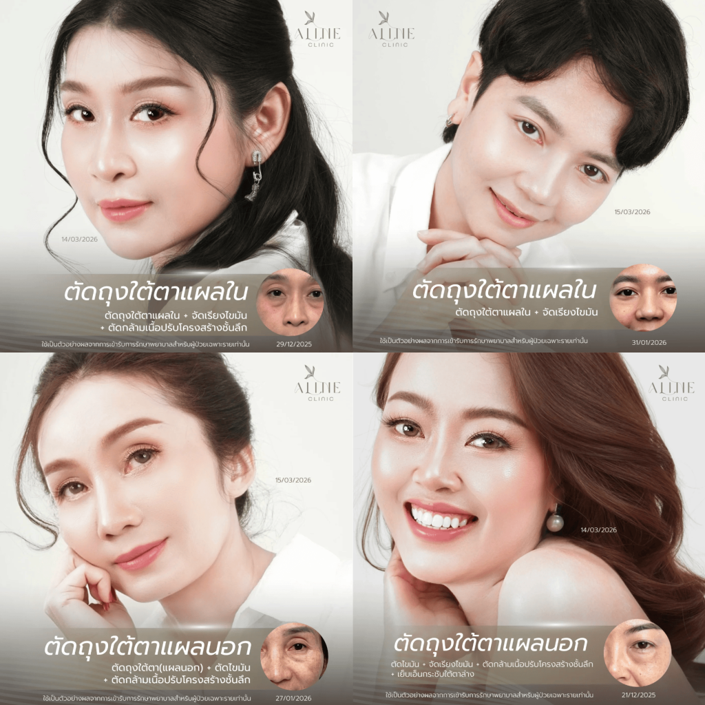 รีวิวผ่าตัดถุงใต้ตาที่ ALINE Clinic