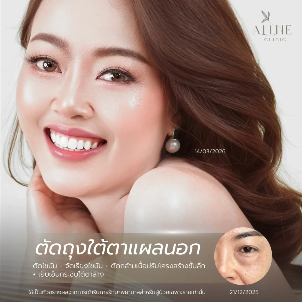 รีวิวผลลัพธ์ผ่าตัดถุงใต้ตาและจัดเรียงไขมัน ที่ ALINE Clinic โคราช