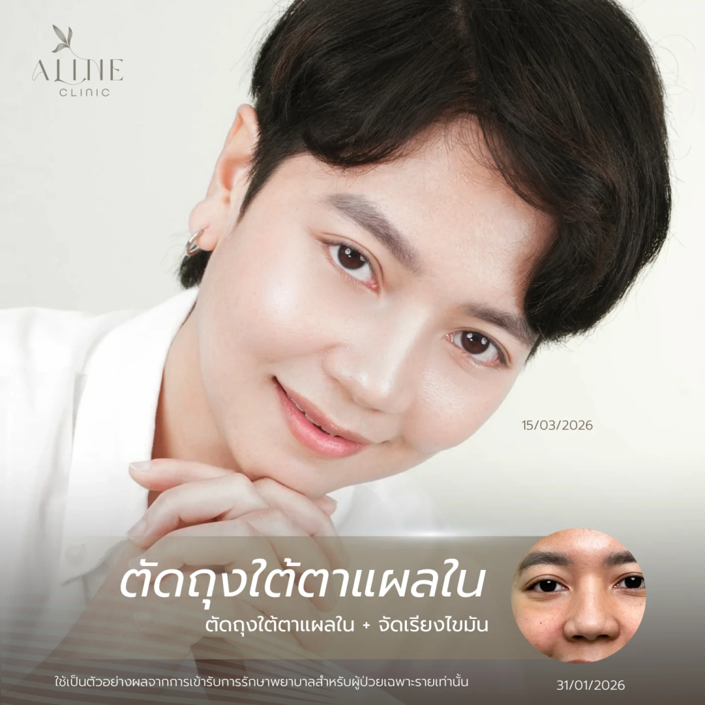 รีวิวผลลัพธ์ผ่าตัดถุงใต้ตาและจัดเรียงไขมัน ที่ ALINE Clinic โคราช