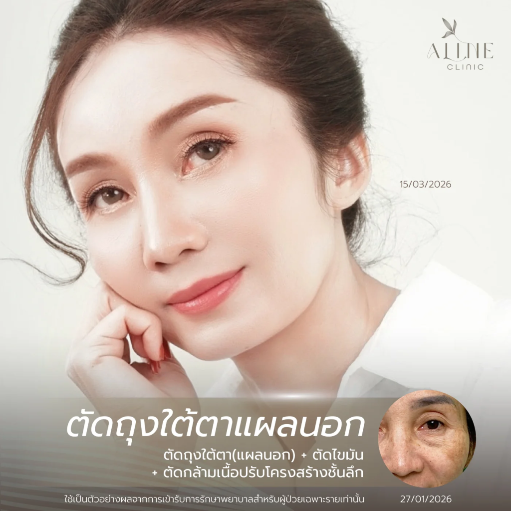 รีวิวผลลัพธ์ผ่าตัดถุงใต้ตาและจัดเรียงไขมัน ที่ ALINE Clinic โคราช